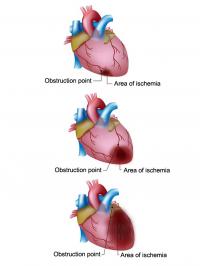 Myocardial Infarction