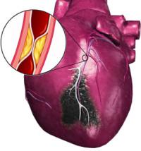 Myocardial infarction