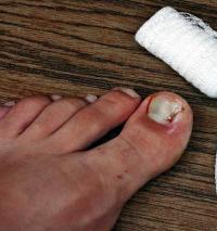 Nail ingrown