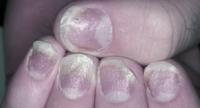 Nail psoriasis