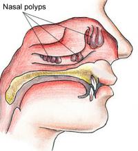 Nasal polyps