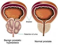 Normal and enlarged prostate