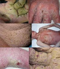 Norwegian scabies
