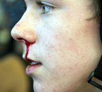 Nosebleed