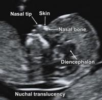 Nuchal translucency