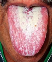 Oral candidiasis