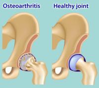 Osteoarthritis