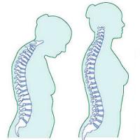 Osteoporosis