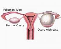 Ovarian cyst