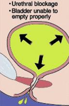 Overflow incontinence