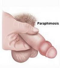 Paraphimosis