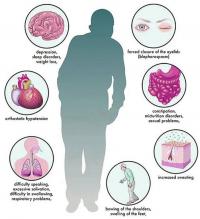 Parkinson`s disease symptoms