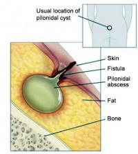 Pilonidal cyst