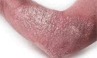 Plaque psoriasis