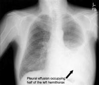 Pleural effusion roentgen