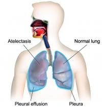 Pleural effusion