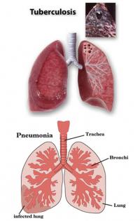 Pneumonia and tuberculosis lungs
