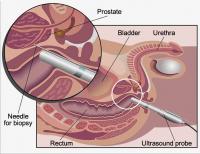 Prostate biopsy