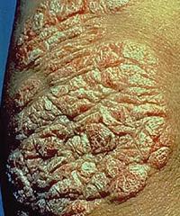 Psoriasis