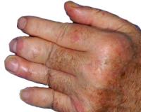 Psoriatic arthritis