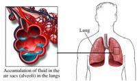 Pulmonary edema