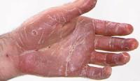 Pustular psoriasis