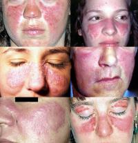 Rash on face