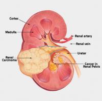 Renal carcinoma