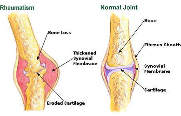 Image result for rheumatism symptoms and treatment