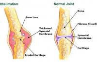 Rheumatism
