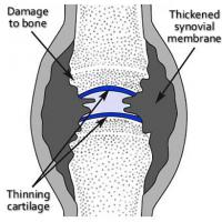 Rheumatoid arthritis