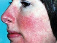 Rosacea