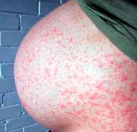 Rubella rash