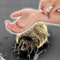 Scabies in human