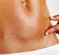 Scar after cesarean section