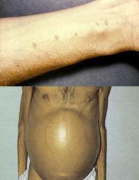 Schistosomiasis