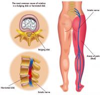 Sciatica pain