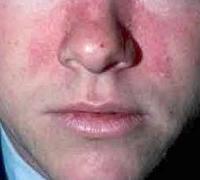 Seborrheic dermatitis
