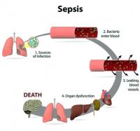 Sepsis