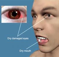 Sjogren syndrome symptoms