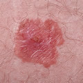 Skin cancer