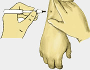 Skin cancer biopsy