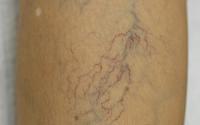 Spider veins