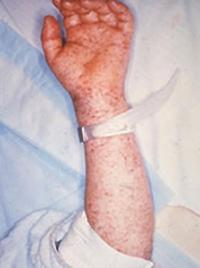 Spotted Fever