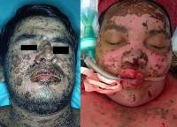 Stevens-Johnson syndrome and toxic epidermal necrolysis