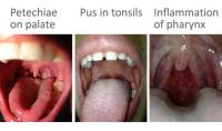 Streptococcal pharyngitis