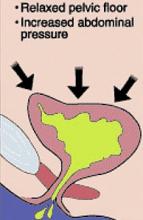 Stress incontinence