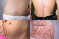 Stretch marks