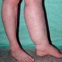 Swelling in the legs