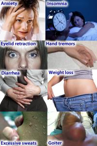 Symptoms of hyperthyroidism